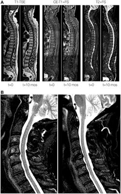 First Report of IgG4 Related Disease Primary Presenting as Vertebral Bone Marrow Lesions